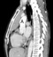 Axial and sagital reconstruction from a contrast enhanced chest CT at the level of the <strong>ascending aorta(A)</strong> demonstrates an anterior medastinal mass. The mass shows a small regions of heterogeneity with a low attenuation region, and abuts the anterior aspect of the pericardium. There is a lobulated contour that abuts the lung . At surgery, the thymoma was found to invade the medaistinal fat as well as the right lung, without invasion into the aorta or other mediastinal vessels .